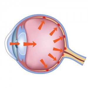 Glaucoma